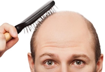 Genetik yatkınlık, saç dökülmesini tetikleyebilir