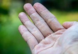 Nemli eller kuru ellere kıyasla bin kata kadar daha fazla bakteri taşıyabiliyor