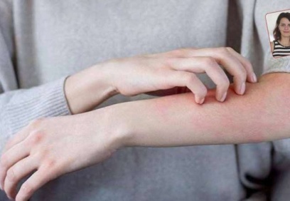 Uyuz hızla yayılıyor, devlet uyuz ilacının parasını ödemiyor