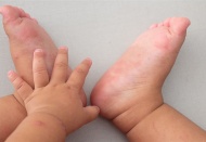 Deprem bölgesinde, el ayak ağız hastalığı yayılıyor