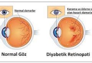 Diyabetik retinopati, körlükle sonuçlanabilir