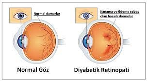 Diyabetik retinopati, körlükle sonuçlanabilir