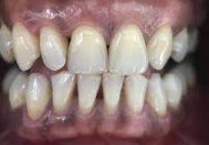 Sigara içenlerde diş eti hastalıkları şiddetleniyor