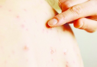 Avrupa’da kızamık yaygınlaşıyor