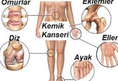 Primer kemik tümörlerinde de erken teşhis hayat kurtarır
