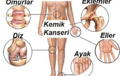 Primer kemik tümörlerinde de erken teşhis hayat kurtarır