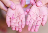 Kızamıkta korkutan vaka sayısı artışı; 27 yıl sonra en yüksek sayıda