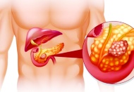 Pankreas kanseri erken dönemde belirti vermiyor