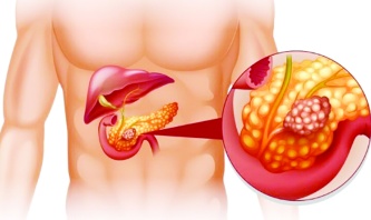 Pankreas kanseri erken dönemde belirti vermiyor