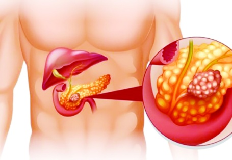 Pankreas kanseri erken dönemde belirti vermiyor