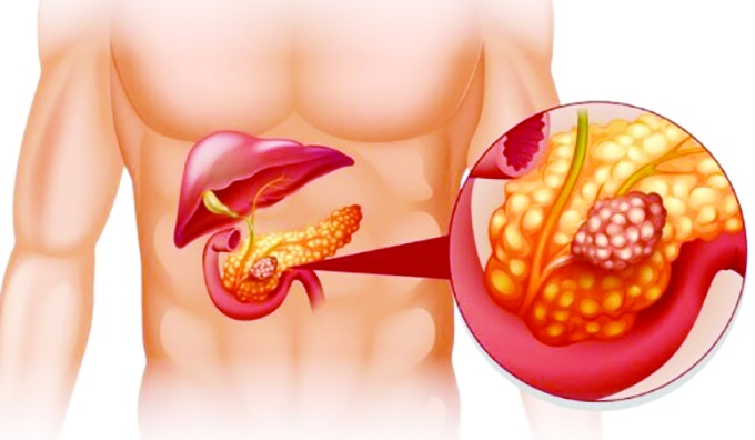 Pankreas kanseri erken dönemde belirti vermiyor