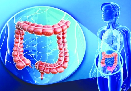 Kolorektal kanser dünya çapında en yaygın üçüncü kanser türü