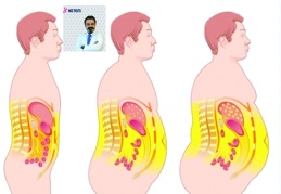 Obezitenin önemli nedenlerinden biri insülin direnci