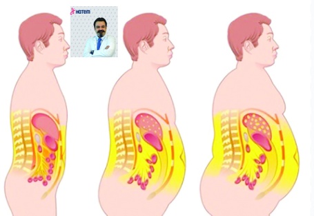 Obezitenin önemli nedenlerinden biri insülin direnci
