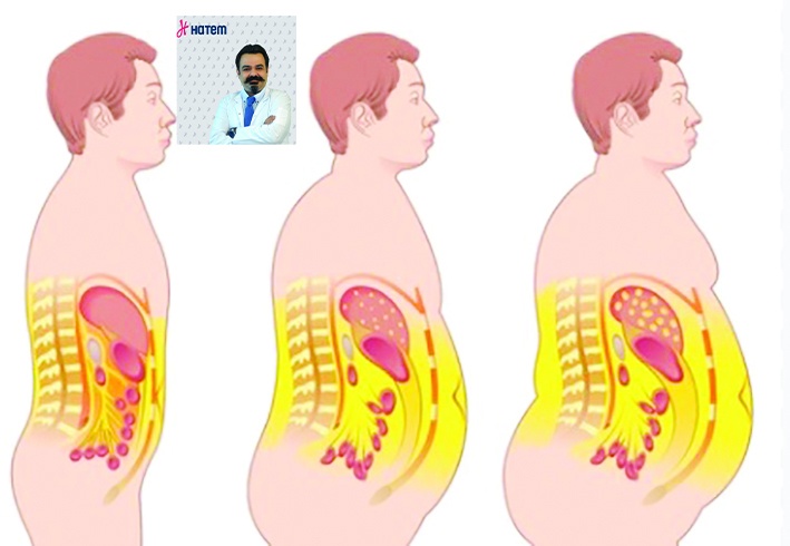 Obezitenin önemli nedenlerinden biri insülin direnci
