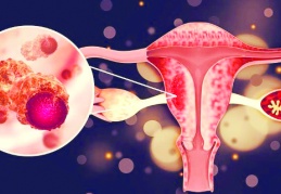 Serviks Kanseri önlenebilir bir hastalık