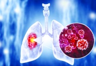 Akciğer kanseri önlenebilir