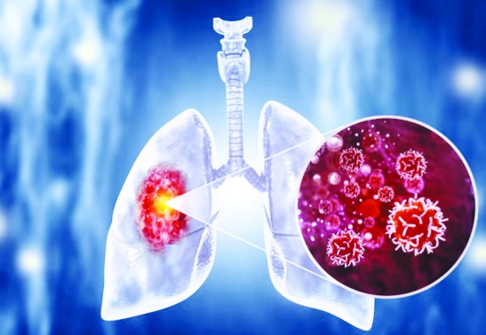 Akciğer kanseri önlenebilir