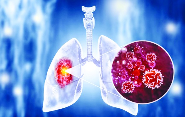Akciğer kanseri önlenebilir