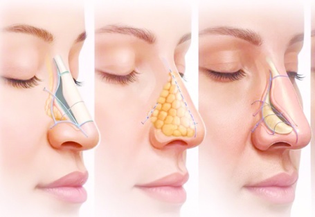 Rinoplastiye yoğun ilgi… Her gün onlarca insan aynı operasyonu geçiriyor