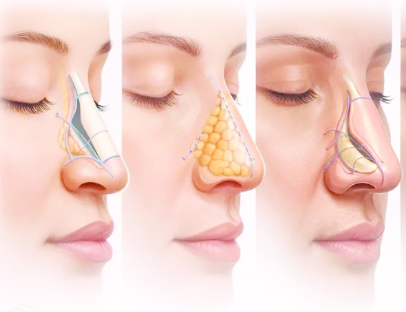 Rinoplastiye yoğun ilgi… Her gün onlarca insan aynı operasyonu geçiriyor