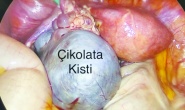 Çikolata kisti en sık yumurtalıkta görülüyor