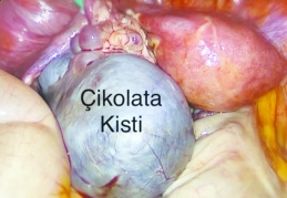 Çikolata kisti en sık yumurtalıkta görülüyor