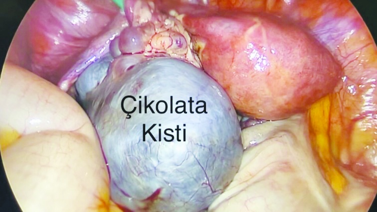 Çikolata kisti en sık yumurtalıkta görülüyor
