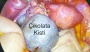 Çikolata kisti en sık yumurtalıkta görülüyor