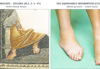 1800 yıllık Zeugma mozaiğinde  “ekinus tipi ayak deformitesi”