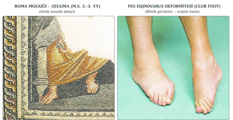 1800 yıllık Zeugma mozaiğinde  “ekinus tipi ayak deformitesi”