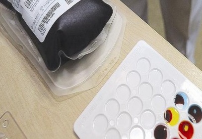 250 bin kişide bir görülüyor