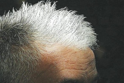 Beyaz saç hastalık habercisi olabilir