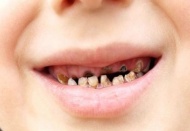 Çürük dişler böbrekleri vuruyor