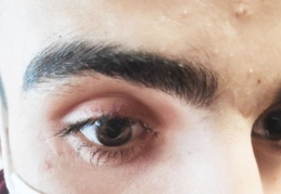 Gözünde, 2 santimetrelik cam kırığı unutuldu