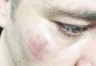 Haber takibindeki İHA muhabirine çirkin saldırı