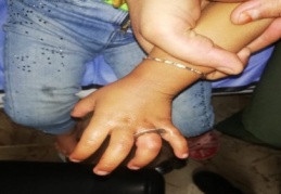 Parmağına sıkışan cıvata pulunu itfaiye ekipleri çıkardı 
