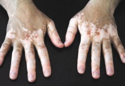 Vitiligo tedavisinde umut ışığı