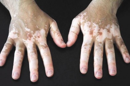 Vitiligo tedavisinde umut ışığı