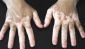 Vitiligo tedavisinde umut ışığı