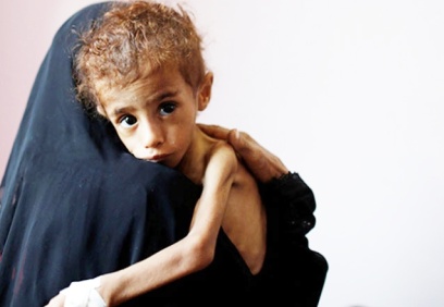 Yemen'de 400 bin çocuk açlıktan ölmek üzere