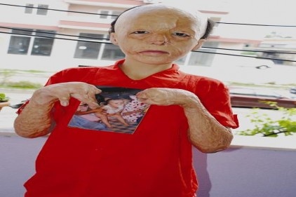 Yüz nakli için para lazım
