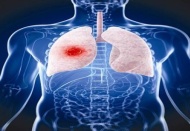 Zatürree en çok ölüme neden olan hastalık